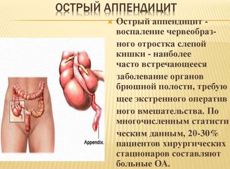 osnovnye-simptomy-appenditsita-opisanie-foto